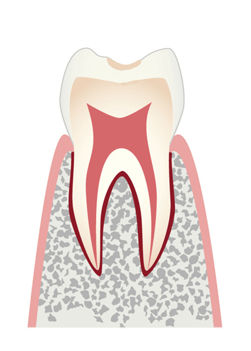 虫歯の前段階